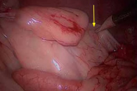 Ovariectomie par laparoscopie