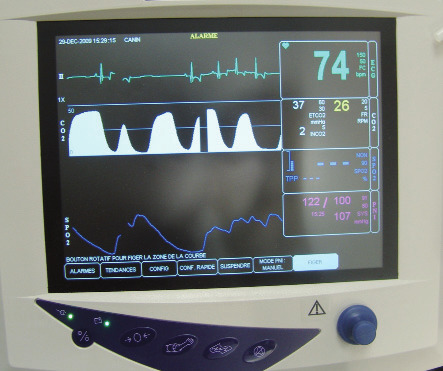 La surveillance clinique peut être double d’une surveillance instrumentale.