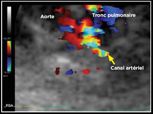 Photo 1 - Persistance du canal artériel visible en mode Doppler couleur sur une vue petit axe transaortique par abord parasternal droit.