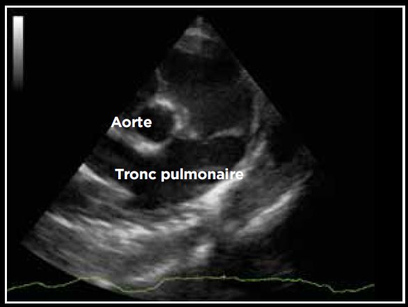 Photo 12 - Dilatation du tronc pulmonaire. Coupe transaortique abord parasternal droit. TP/Ao > 1.