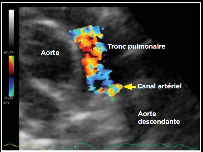 Photo 2 - Persistance du canal artériel, mode Doppler couleur sur une vue crâniale par abord parasternal gauche.