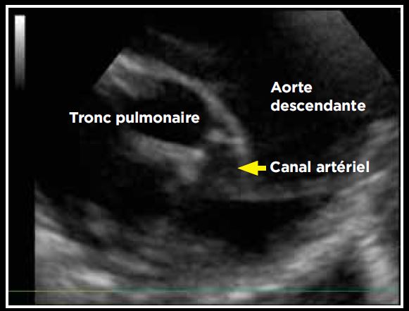 Photo 3 - Persistance du canal artériel, mode bidimensionnel sur une coupe longitudinale des gros vaisseaux par abord parasternal crânial et dorsal gauche.