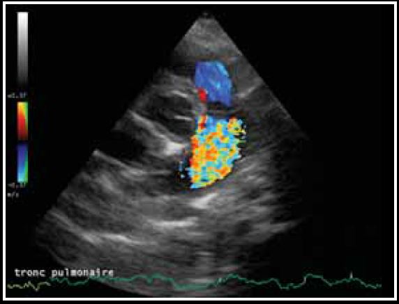 Photo 4 - Turbulences importantes dans le tronc pulmonaire, mode Doppler couleur, coupe transaortique par abord parasternal droit
