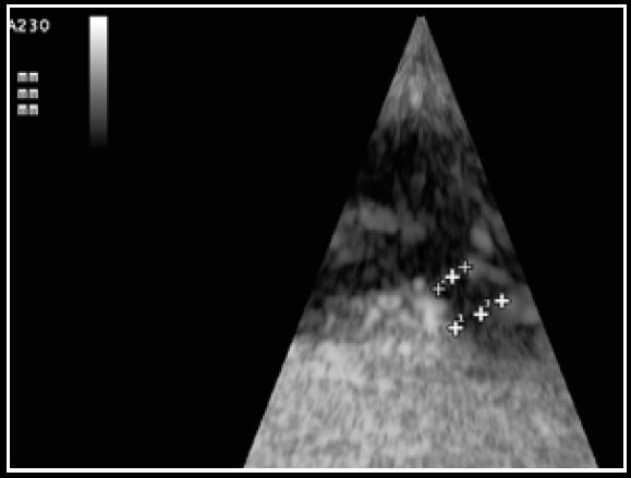 Photo 5 - Mesure des trois principales dimensions du canal artériel : largeur à la naissance et à l’abouchement, longueur.