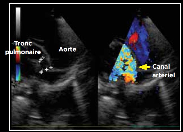 Photo 6 - Détermination du sens du flux en mode Doppler couleur: shunt gauche-droit avec des turbulences importantes dans le tronc pulmonaire. Mesure simultanée des dimensions du canal en mode bidimensionnel.