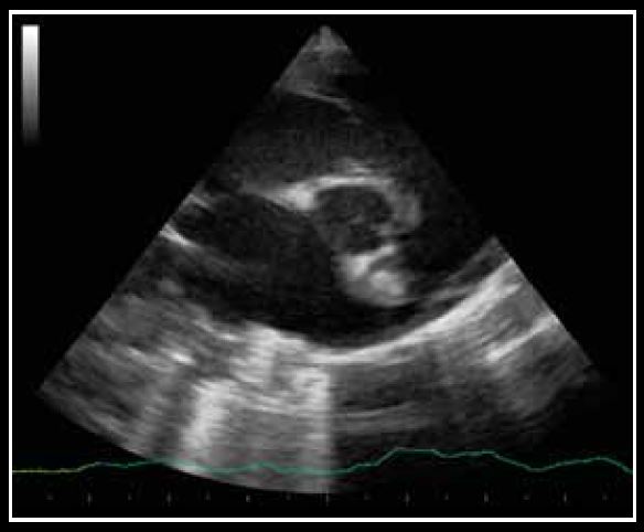 Photo 9 - Dilatation atriale gauche.