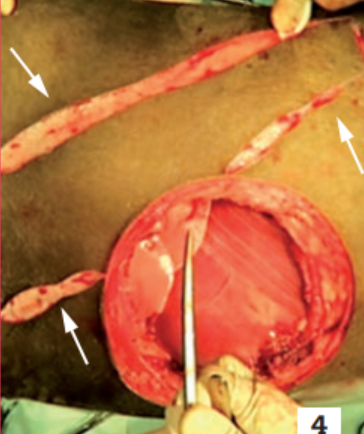 Photo 4 - Réalisation du lambeau musculo-cutané provenant du muscle grand dorsal