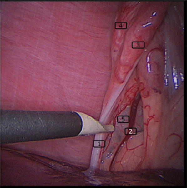Figure 1 - Anatomie de l’ovaire en laparoscopie