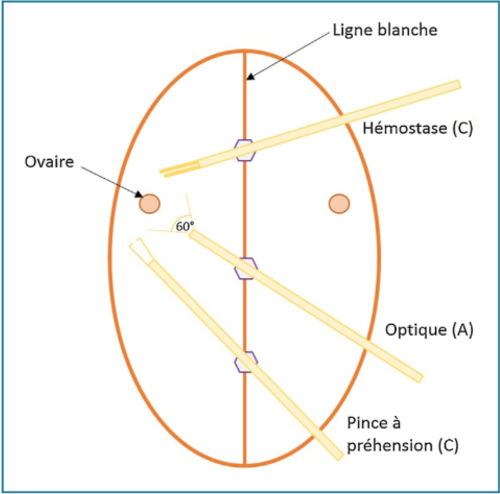 Figure 3 - Ovariectomie à trois ports