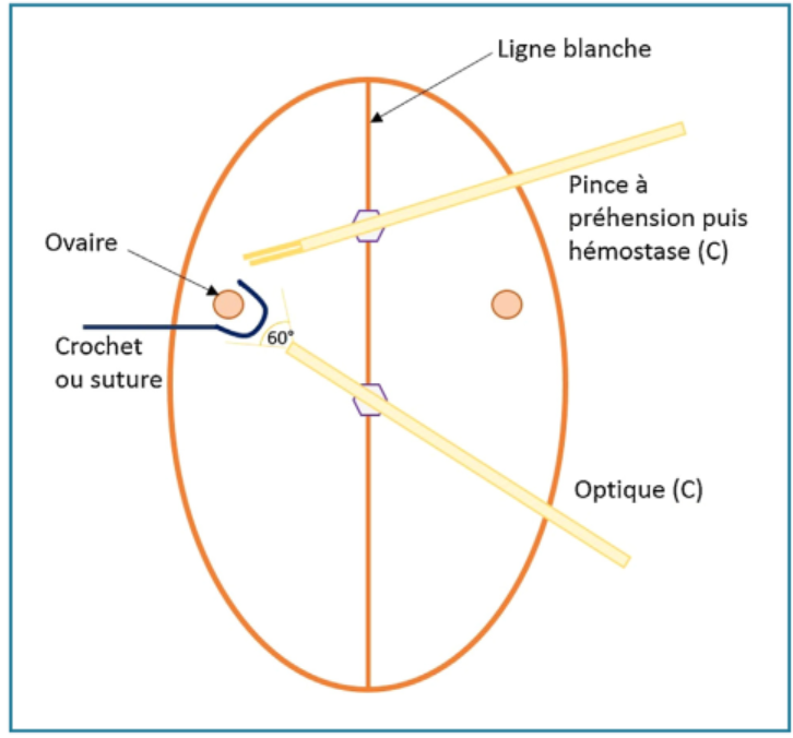 Figure 4 - Ovariectomie à deux ports