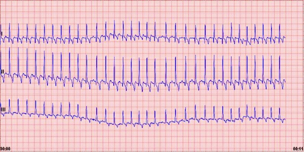 Electrocardiogramme Conventionnel