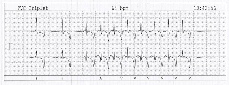 Extrait choisit d'un électrocardiogramme Holter