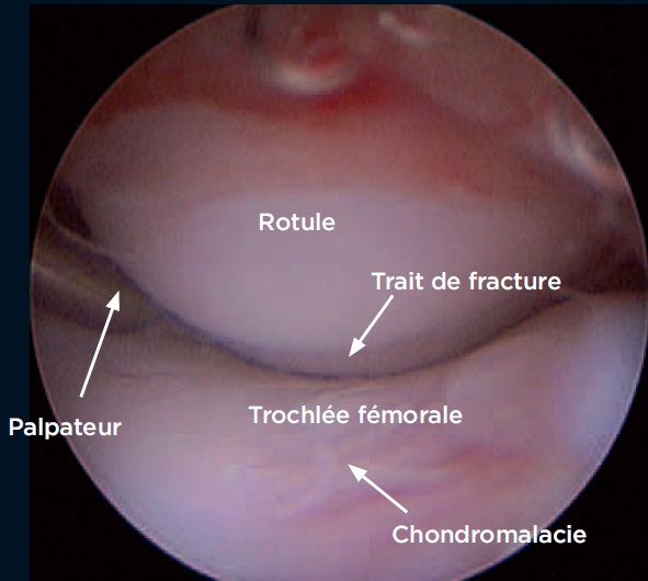 Photo 1 - Fracture transverse de la rotule.