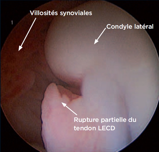 Photo 2 - Rupture partielle du tendon du long extenseur commun des doigts.