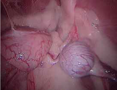 Visualisation laparoscopique du testicule abdominal à droite de la vessie.
