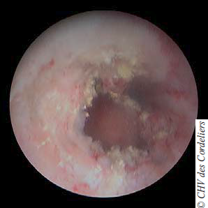 Photo 10 : Image cystoscopique d’un carcinome à cellules transitionnelles urétral.