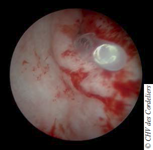 Photo 11 : Utilisation d’une sonde urinaire canine comme stent urétral après microdébridage au shaver.