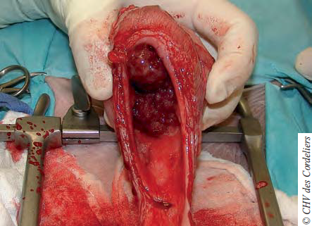 Photo 6 : Nodule vaginal fermant le méat urinaire.