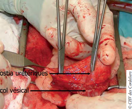 Photo 7 : Visualisation du trigone après cystectomie.