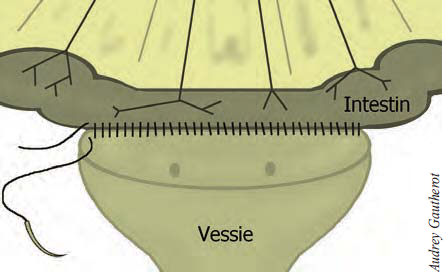 Figure 1 : Suture de la paroi vésicale à la séro-musculeuse intestinale