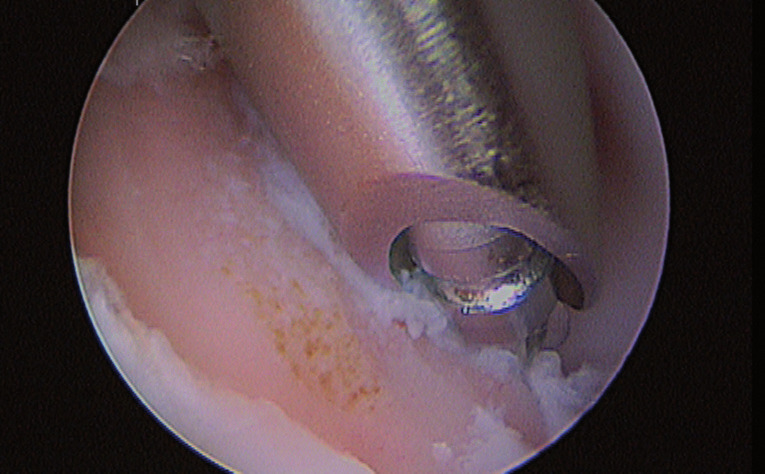Photo 10 - Ablation du cartilage malade au shaver