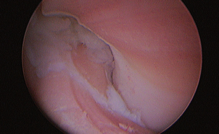 Photo 11 - Syndrome du compartiment médial : noter l’abrasion profondes de toutes les surfaces articulaires.