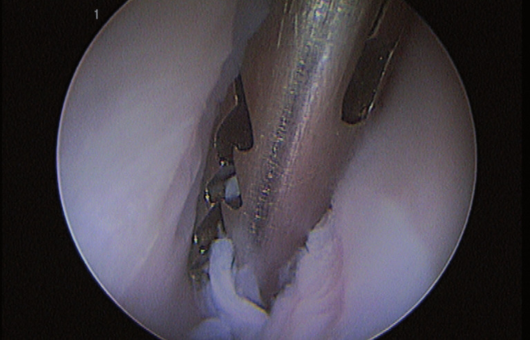 Photo 9 - Extraction du fragment osseux.