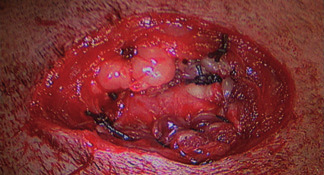 Photo 5 - Suture de la séromusculeuse au muscle transverse, aspect final.