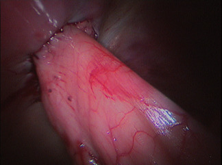 Photo 6 - Aspect de la pexie, vue laparoscopique.