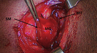 Photo 4 - Séparation de la séromusculeuse (SM) de la muqueuse gastrique (MG). MT= muscle transverse.