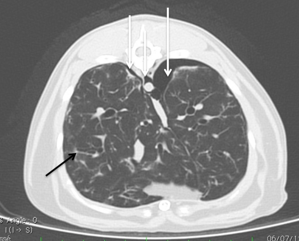 Photo 3 - Examen tomodensitométrique du thorax réalisé sous anesthésie générale.