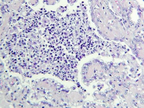 Photo 7 : Examen histologique de la lésion pulmonaire