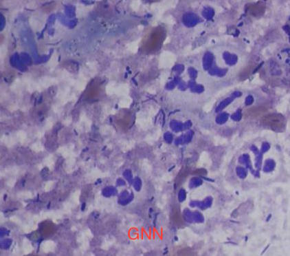 Photo 2 : Cytologie rectale.