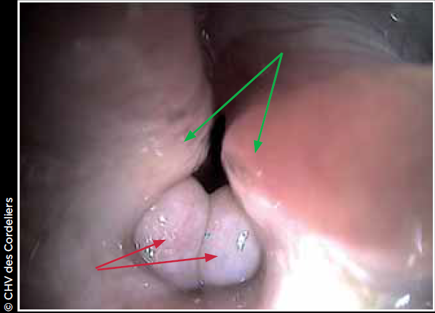 Photo 3 - Eversion des ventricules laryngés (flèches rouges) et ptose des aryténoïdes (flèches vertes)