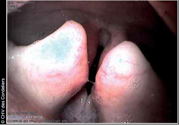 Photo 4 - Collapsus laryngé : les cartilages arythénoïdes présentent une adduction anomale et ferment la glotte