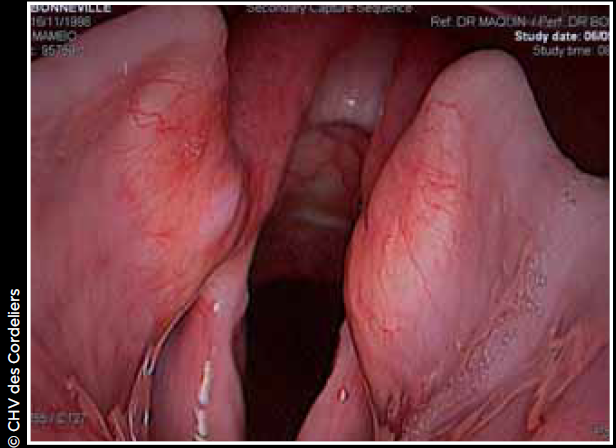 Photo 5 - Inflammation de la muqueuse laryngée