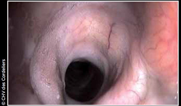 Photo 6 - Hypoplasie trachéale : noter le rétrécissement du diamètre trachéal derrière le larynx et l’inflammation de la muqueuse trachéale